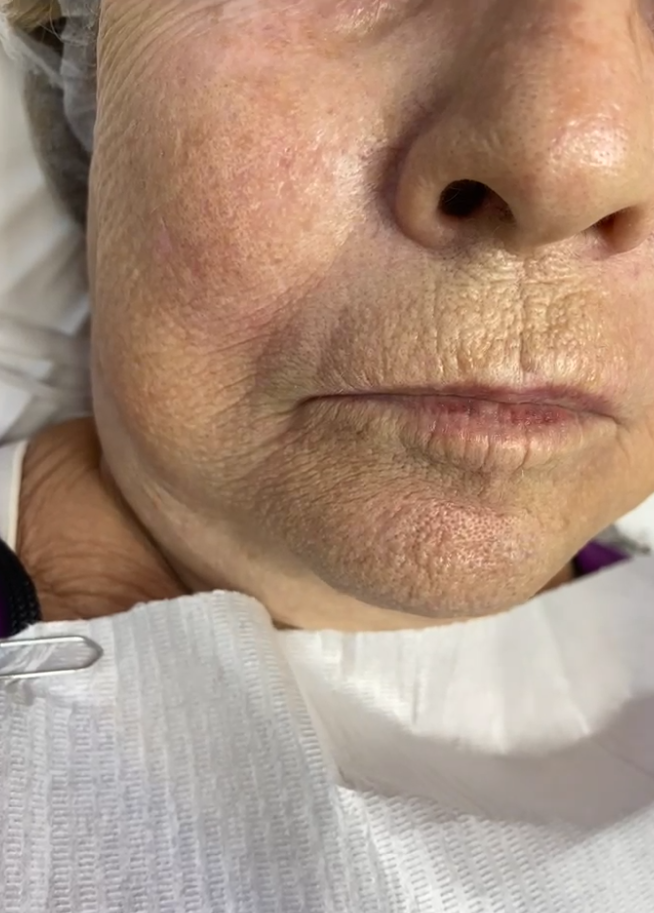 Lábios — Full Lips - antes e depois