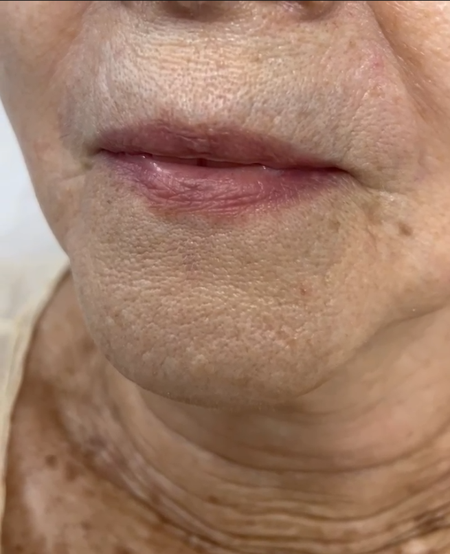 Lábios — Soft Lips - antes e depois