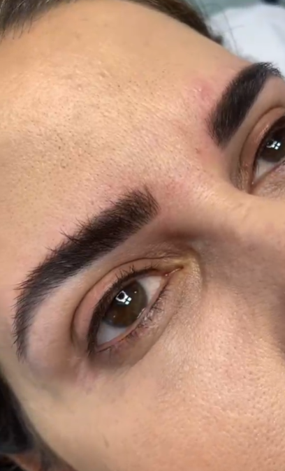 Olhos — Raiz de cílios - resultado